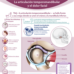 Spanish TMJ and Facial Pain Infographic PDF (La articulación temporomandibular y el dolor facial)