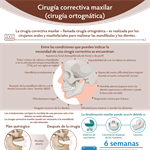 Spanish Corrective Jaw Surgery Infographic PDF (Cirugía correctiva maxilar [cirugía ortognática])