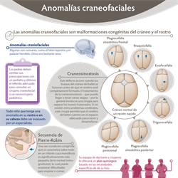 Spanish Craniofacial Surgery Infographic PDF (Anomalías craneofaciales)