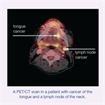 Oral, Head and Neck Cancer Patient Information Pamphlet (100-Pack)