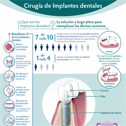 Spanish Dental Implant Surgery Infographic PDF  (Cirugía de Implantes dentales)