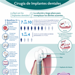 Spanish Dental Implant Surgery Infographic PDF  (Cirugía de Implantes dentales)